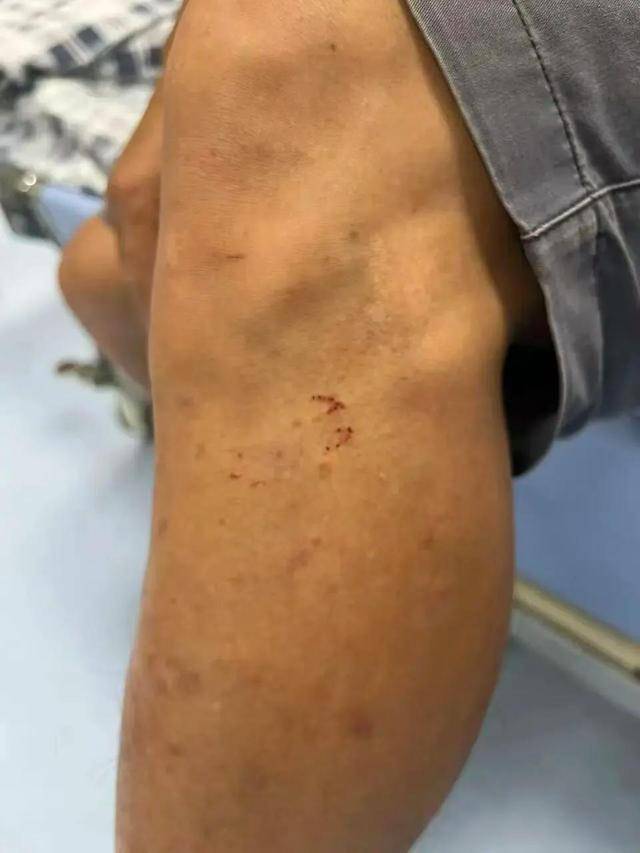 廣東62歲阿叔網(wǎng)魚網(wǎng)到2條眼鏡蛇<strong></p>
<p>宏鑫機(jī)械設(shè)備有限公司
</strong>，被咬傷后當(dāng)場打死，并打包提進(jìn)醫(yī)院:宏鑫機(jī)械設(shè)備有限公司
