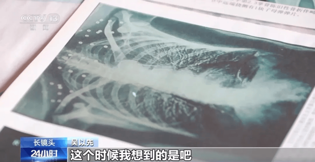 “老先生<strong></p>
<p>宏鑫機(jī)械設(shè)備有限公司
</strong>，您把項(xiàng)鏈取下來再做CT”:宏鑫機(jī)械設(shè)備有限公司
