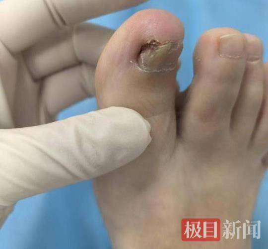 六旬女子被甲溝炎折磨了三年，專家30分鐘手術(shù)解難題:宏鑫機械設(shè)備有限公司
